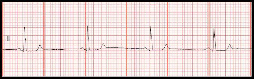 Telemetry Technician Course Sinus Rhythm Quiz Class 5