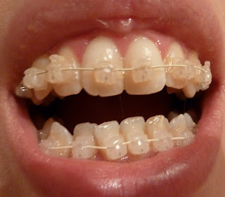  A front on photograph of open teeth with ceramic fixed braces at week 4 of treatment
