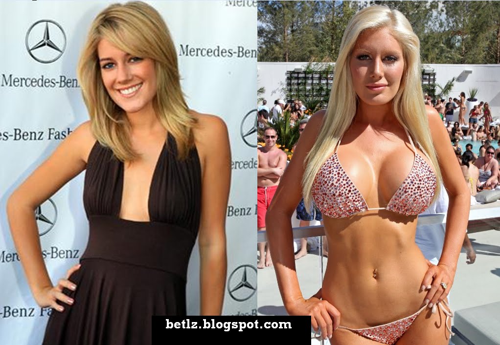 heidi montag before and after 10 surgeries. Heidi Montag Before (L) and