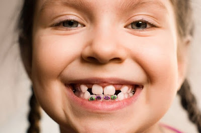 Lứa tuổi nào nên niềng răng ở trẻ?