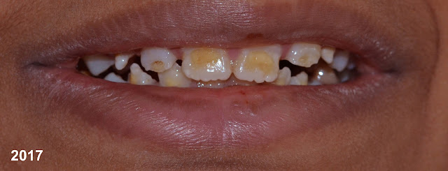 Before Treatment || Enamel Hypoplasia