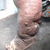 ELEPHANTIASIS IS SPREADING SO FAST AT AMPATAANO