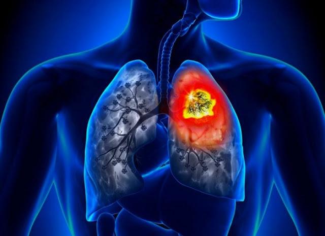 ALK Positive Lung Cancer Treatment Market