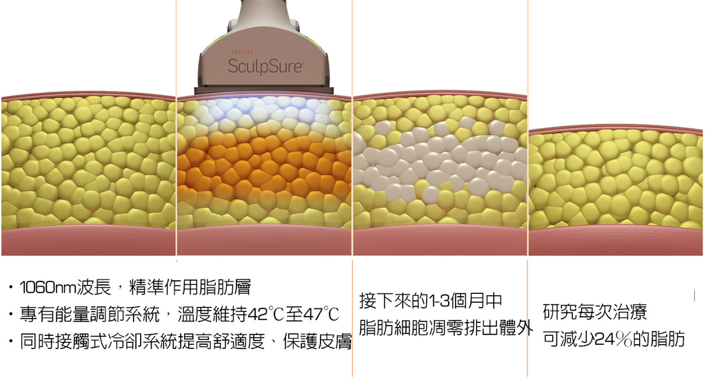 SculpSure體雕減肥絲酷秀術後修復價格恢復期雷射體雕二極體冷凍溶脂減肥日記費用減肥食譜術後雷射溶脂局部平坦小腹塑身曲線雕塑林上立上立皮膚科診所1.jpg