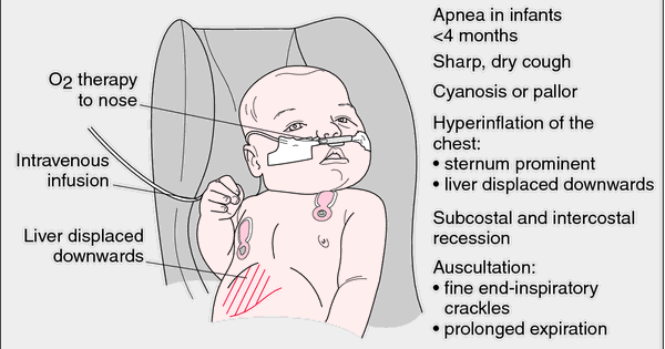 Merawat Bronchiolitis pada Bayi