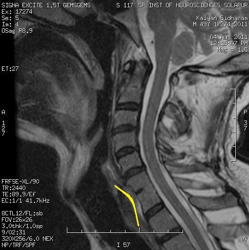 Dr Balaji Anvekar FRCR: 'Wasp waist' sign of Congenital fusion on MRI