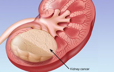 Complex Cyst on Kidney Cancer.