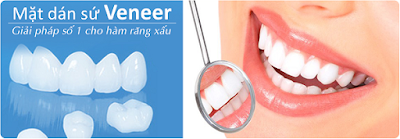 Phương pháp bọc răng sứ Veneer