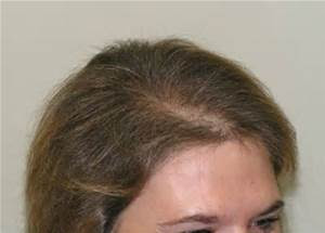 Causes Of Hair Loss in Women