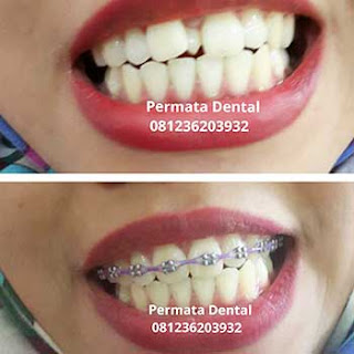 gambar foto behel bracket kawat gigi sebelum dan sesudah perawatan untuk memperbaiki merapikan gigi gingsul gigi miring renggang tonggos berantakan keluar masuk jarang diastema maju mundur tidak rapi tidak beraturan bali denpasar banyuwangi jember tidak rata kocar kacir