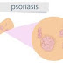 Psoriasis: Pictures, Symptoms, Causes, Diagnosis, Treatment
