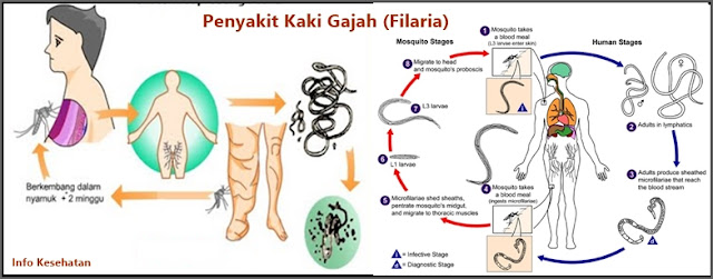 Penyebab Penyakit  Kaki  Gajah  Filaria Serta Cara 