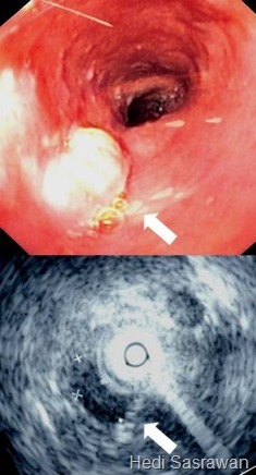 Kerongkongan atau esofagus ialah organ yang terdiri dari otot berbentuk tabung untuk memb 5 Gambar Kerongkongan Manusia
