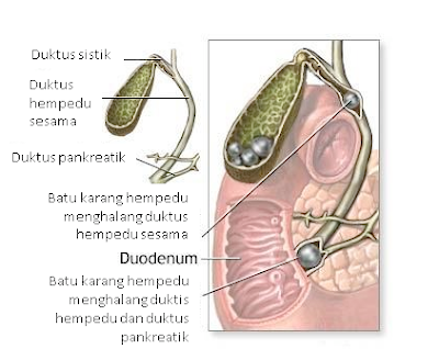 batu hempedu