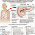 The Common Pancreatic Cancer Causes