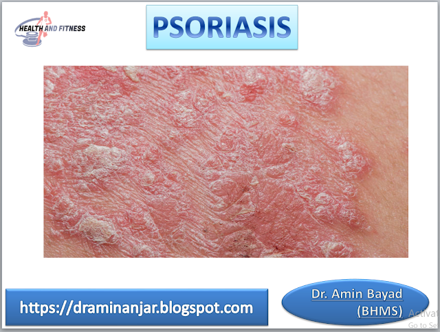 Sing and symptoms of psoriasis 