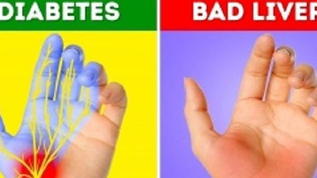 Diabetes hingga Liver, Penyakit Berbahaya Ini Dapat Dideteksi Lewat Tangan Anda