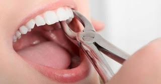 Diş Apsesi İçin Antibiyotik Diş Apsesi Nedir Apseli Diş Çekilir mi?