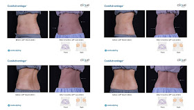 CoolSculpting Treatment, Clique Clinic, CoolSculpting Review, Slimming, Beauty 