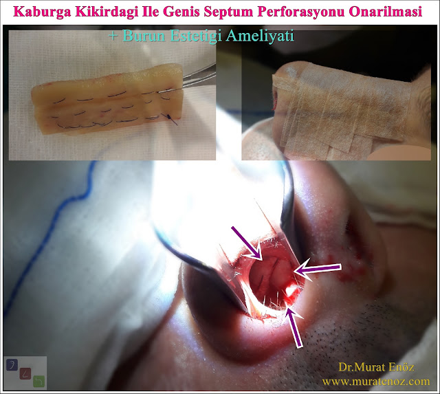 Septum perforasyonu tanımı - Septum perforasyonu  nedenleri - Septum perforasyonu belirtileri - Septum perforasyonu tedavisi - Açık teknik septum perforasyonu ameliyatı - Açık teknik septum perforasyonu onarımı - Burun duvarında delik