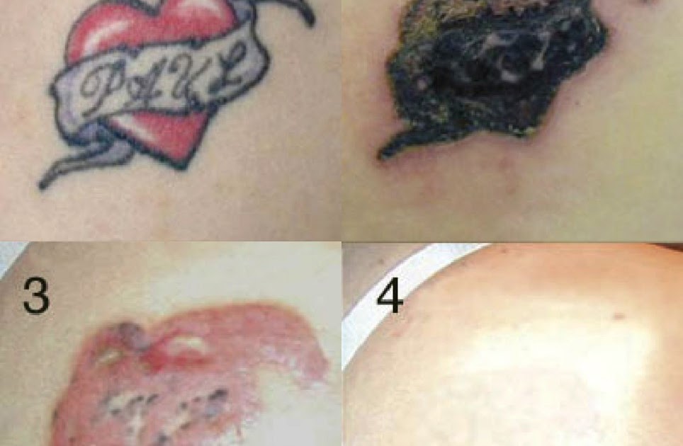 Concealing Cream Pictures to Pin on Pinterest - TattoosKid