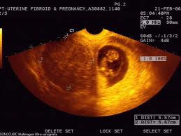 Fibroid Dan Kehamilan Shiemz Shiemz