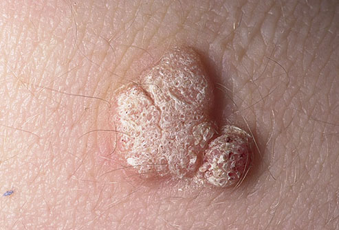 common wart images. dresses wart diagram. common