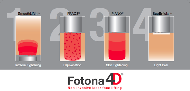 fotona 4d laser face lifting malaysia