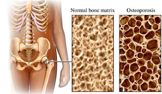 ostematrix shaklee, ostematrix bukan sekadar kalsium, pil kalsium, kalsium dalam bentuk pil