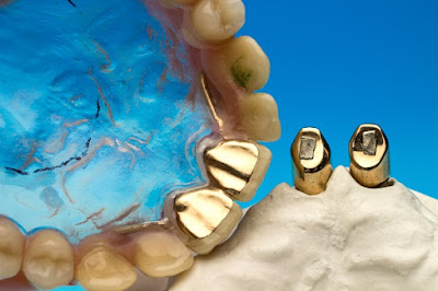  Các loại răng sứ phổ biến 