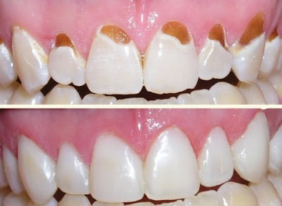 Cạo vôi răng có làm trắng răng hay không?