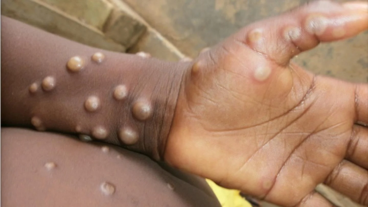 Europe is currently experiencing the largest prevalence of monkeypox cases in its history, with Spain and Portugal announcing confirmed and suspected cases.    While orbital disease tightens its grip on the continent, the UK Health Security Agency (UKHSA) asks "everyone" to be aware of the main symptoms.    Two more people have been diagnosed with monkey chickenpox in the UK since the beginning of May, bringing the total number of infections to nine.