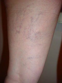 varicose veins, varicose veins treatment, what causes varicose veins, varicose veins causes, varicose veins symptoms, how to get rid of varicose veins, what are varicose veins, when to worry about varicose veins, how to prevent varicose veins, varicose veins pregnancy, varicose veins surgery, are varicose veins dangerous, early stage varicose veins symptoms, varicose veins icd 10, varicose veins stages, treatment for varicose veins, varicose veins medical procedure, varicose veins stockings, spider veins vs varicose veins, varicose veins treatments, do varicose veins hurt, varicose veins in one leg only, how to treat varicose veins, varicose veins in legs, compression stockings for varicose veins, varicose veins in testicles, varicose veins pain, treatment varicose veins, what is varicose veins, varicose veins pain relief, icd 10 code for varicose veins, varicose veins cream, varicose veins treatment near me, varicose veins self-care, how to cure varicose veins with vinegar, vulvar varicose veins, compression socks for varicose veins, vaginal varicose veins, symptoms of varicose veins, varicose veins cause, varicose veins in feet, vulvar varicose veins images, varicose veins vs spider veins, cause of varicose veins, varicose veins testicles, varicose veins medical devices, can varicose veins go away, varicose veins treatment cream, how do you get varicose veins, varicose veins are caused by, are varicose veins painful, varicose veins during pregnancy, pregnancy varicose veins, varicose veins cancer symptoms, painful varicose veins, causes of varicose veins, varicose veins in only one leg, how to get rid of varicose veins in legs, best treatment for varicose veins, varicose veins socks, varicose veins treatment cost, varicose veins compression stockings, laser treatment for varicose veins, blood clot varicose veins, specialist in varicose veins, blood clots varicose veins, compression legging for varicose veins, compression leggings varicose veins, varicose veins in breast, varicose veins compression leggings, compression leggings for varicose veins, icd 10 varicose veins, varicose veins blood clots, varicose veins specialist, varicose veins on breast, blood clots in varicose veins, varicose veins breasts, varicose veins in arms, specialist for varicose veins, varicose veins legs, do varicose veins go away, varicose veins burst bruise, stripping varicose veins, best compression socks for varicose veins, can varicose veins cause a blood clot, varicose veins treatment cost laser, varicose veins for men, varicose veins in stomach, strip varicose veins, how to get rid of varicose veins on legs, varicose veins in the stomach, what do varicose veins look like, varicose veins sclerotherapy, can varicose veins hurt, varicose veins pelvis, varicose veins stripping, varicose veins stripped, how to avoid varicose veins, varicose veins exercise, laser treatment for varicose veins cost,