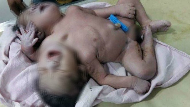 Duh! Bayi di India Lahir Cacat, Punya Dua Kepala dan Tiga Tangan