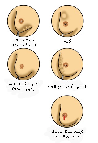 سرطان+الثدي+13 تعرفي على سرطان الثدي ,مدعم بصور توضيحية