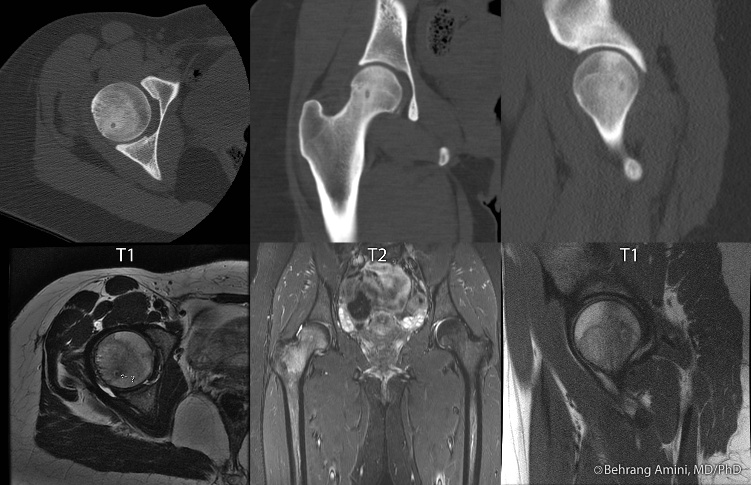 Osteoid Osteoma Hip