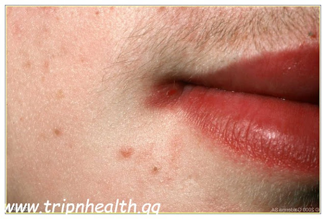 Angular Cheilitis Treatment, Angular Chelitis