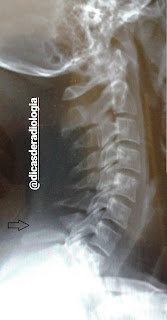 COLUNA VERTEBRAL C7