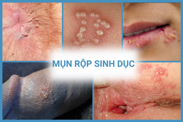 Mụn rộp herpes sinh dục