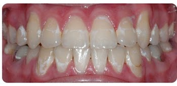Cách khắc phục chân răng bị trắng