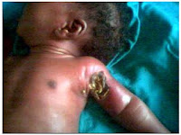 Necrotizing Skin Infections