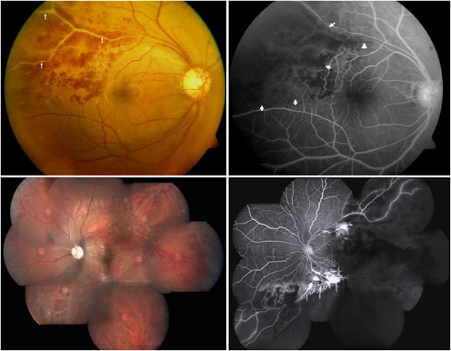A typical fundus picture in Eales’ disease. The colour fundus (top left) of right eye shows obliterated vessels as white lines (arrows), surrounded by retinal haemorrhages; the corresponding angiogram (top right) shows areas of capillary nonperfusion (arrow head) distal to the obliterated vessels. The colour fundus photograph of the left eye (bottom left) shows several areas of obliterated vessels, and suspected new vessels; the corresponding fluorescein angiograph (bottom right) confirms the retinal new vessels, and an extensive area of capillary non perfusion.