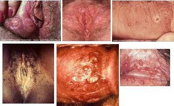 HIDUP MESTI DITERUSKAN: PENYAKIT HERPES GENITAL