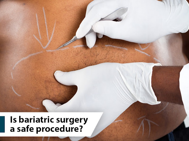 Bariatric Surgery is a safe procedure