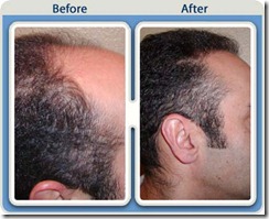 Before and After hair transplant procedure