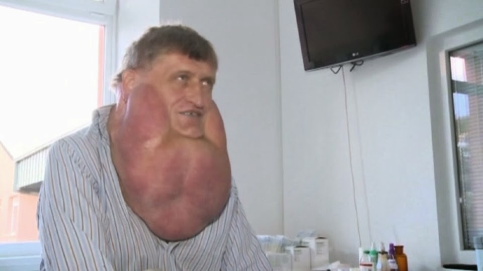 Um homem na Eslováquia teve um tumor 6 kg removido de seu rosto. 