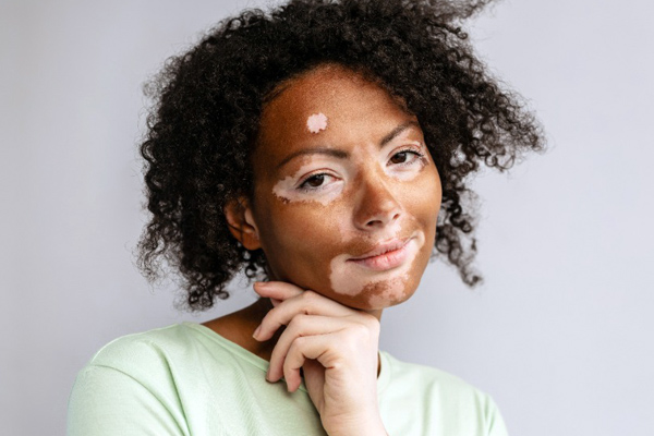 Home Remedies for White Patches