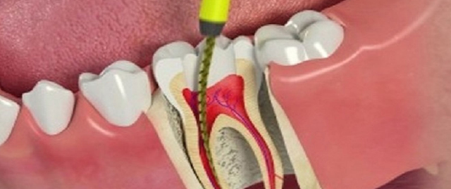 Passos para tratamento de Endodontia