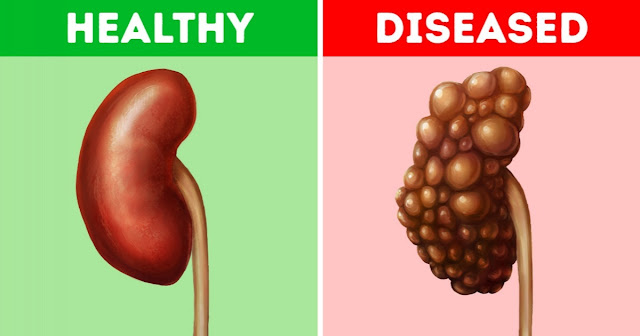 Habits That Damage Your Kidneys