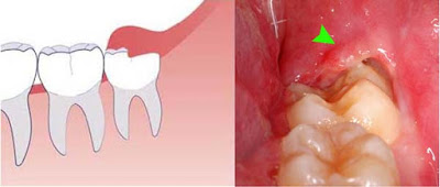 Răng khôn bị chảy máu phải xử lý như thế nào?-1